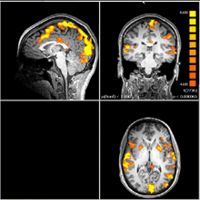 fMRI scan